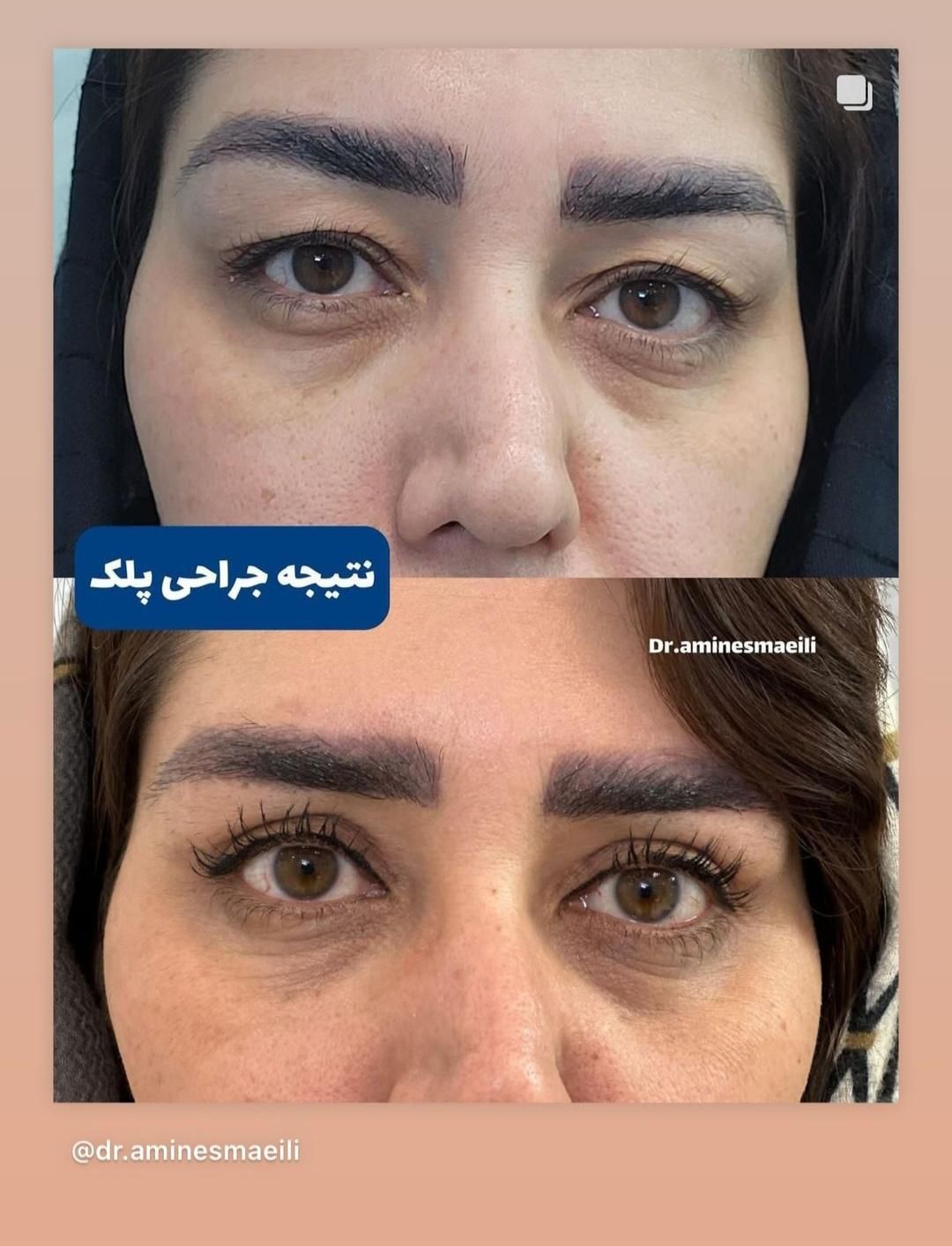 عمل جراحی پلک (بلفاروپلاستی)|خدمات آرایشگری و زیبایی|اصفهان, مسجد مصلی|دیوار