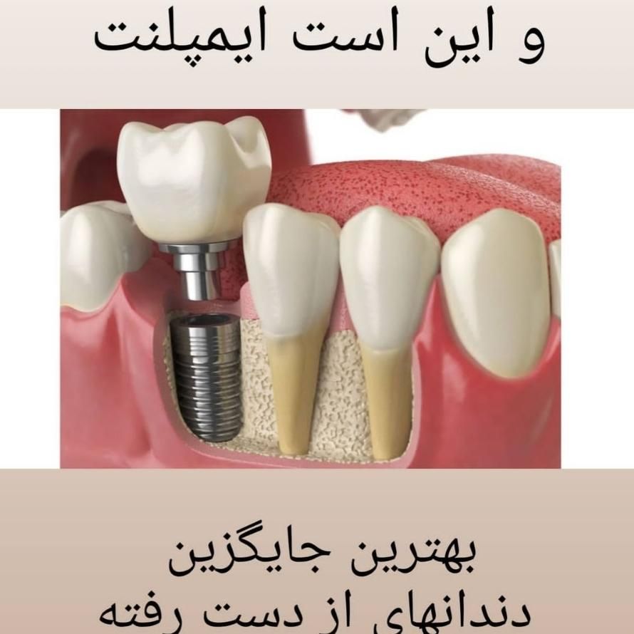 ایمپلنت دندان لمینت کامپوزیت دندانپزشکی|خدمات آرایشگری و زیبایی|اصفهان, هفتون|دیوار