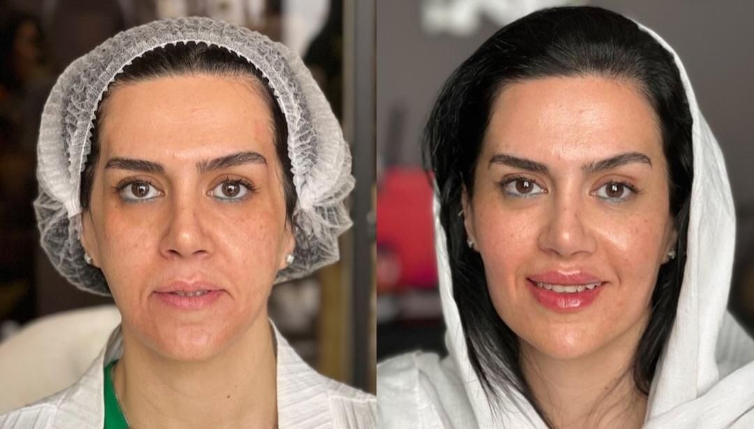 اصلاح فرم صورت.جوانسازی به روش یانگ فیس توسط متخصص|خدمات آرایشگری و زیبایی|مشهد, سناباد|دیوار