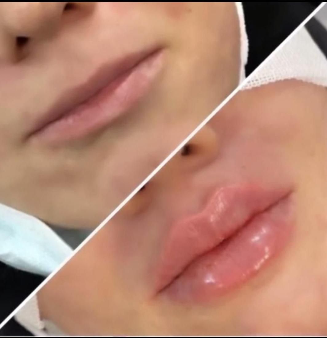 تزریق ژل لب بوتاکس هایفولیزرفیلرلیفت صورت سفیدسازی|خدمات آرایشگری و زیبایی|تهران, صادقیه|دیوار