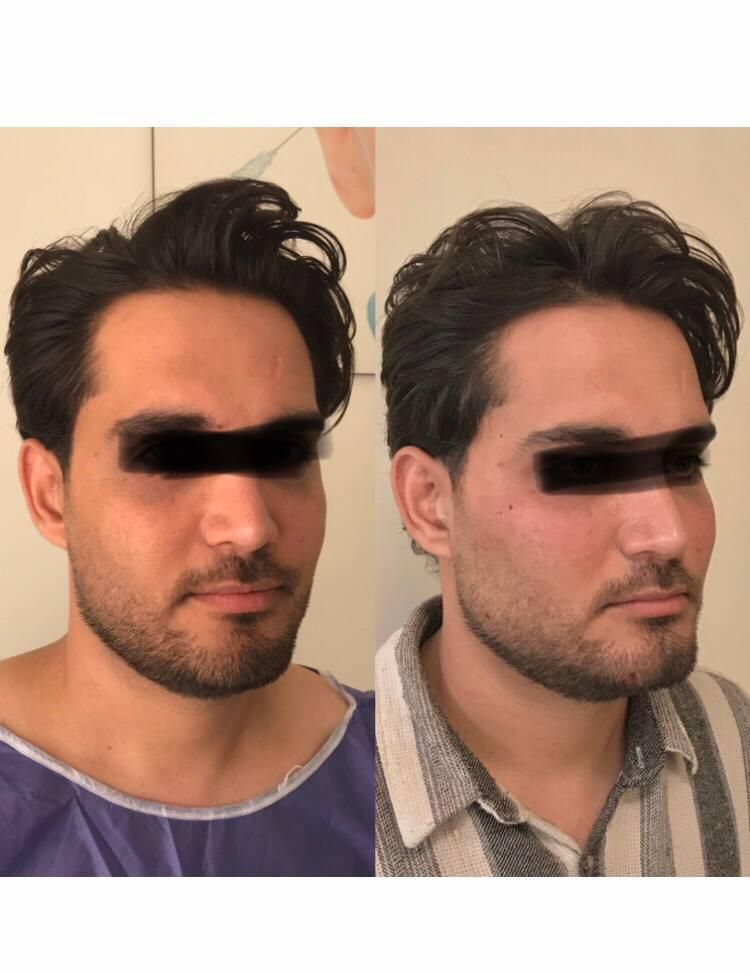 تزریق چربی صورت دست با سن بیکینی در کلینیک تخصصی|خدمات آرایشگری و زیبایی|تهران, صادقیه|دیوار