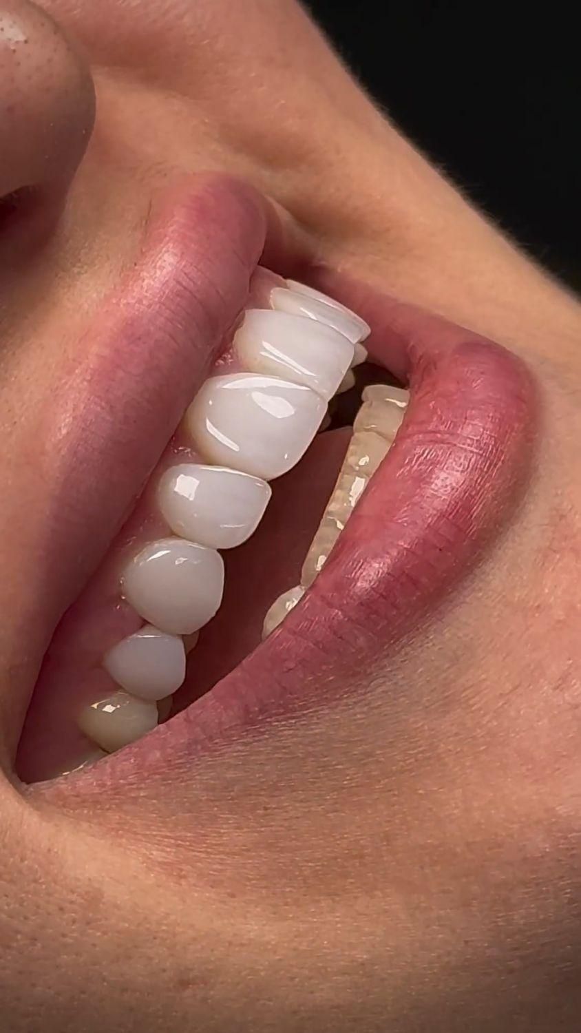 کامپوزیت دندان|خدمات آرایشگری و زیبایی|پاکدشت, خاتون آباد|دیوار