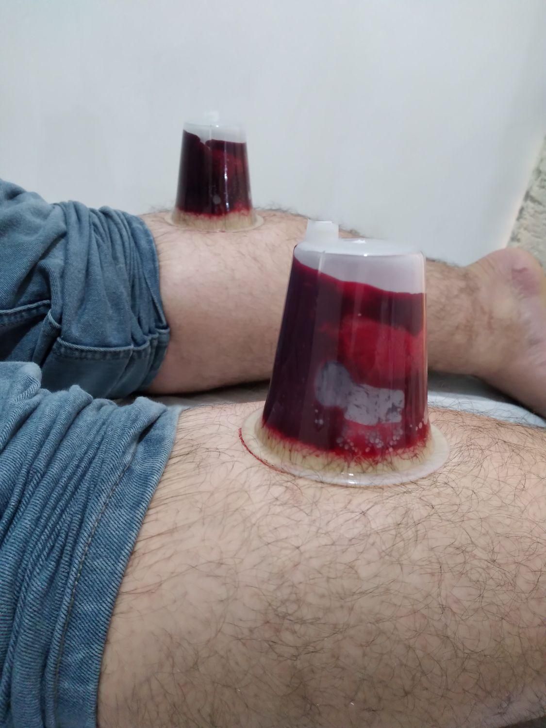 حجامت ٪ زالودرمانی ٪ بادکش ٪ فصد سیاتیک ٪|خدمات آرایشگری و زیبایی|اندیمشک, |دیوار