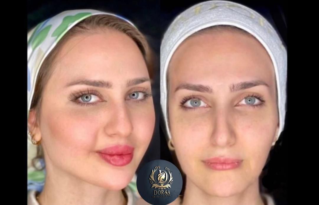 تزریق ژل و بوتاکس و مادلینگ خلیجی و هایفو درکلینیک|خدمات آرایشگری و زیبایی|کرمانشاه, |دیوار