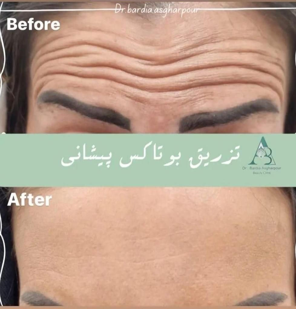جشنواره هایفوتراپی،ژل، بوتاکس،لیزر در کلینیک پزشکی|خدمات آرایشگری و زیبایی|رشت, معلم|دیوار