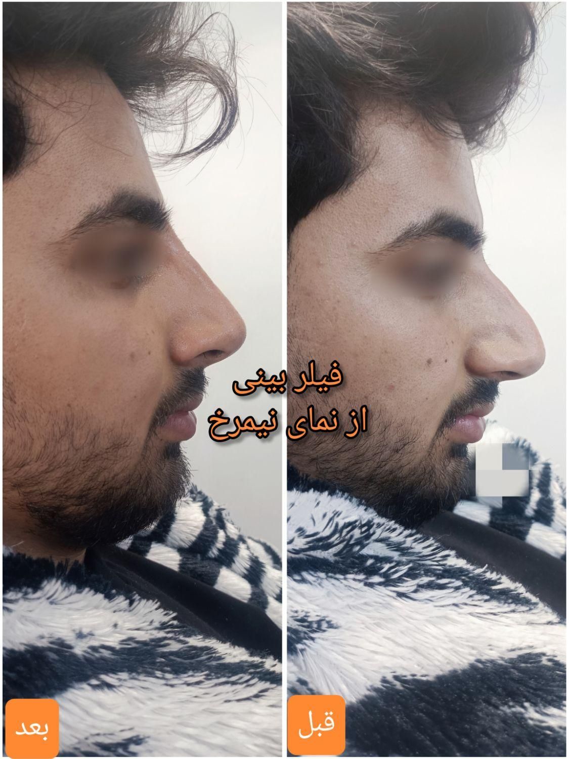 تزریق آنزیم بینی/فیلر بینی/شقیقه/ژل/درکلینیک پزشکی|خدمات آرایشگری و زیبایی|شیراز, زرهی|دیوار