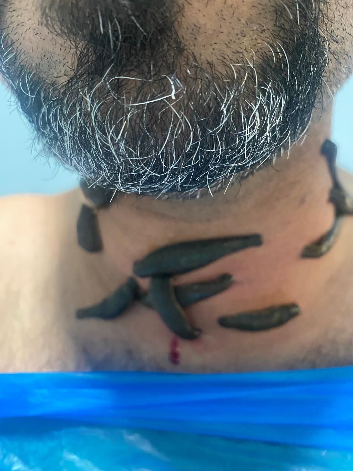 آموزش وانجام تخصصی حجامت زالو،سیاتیک ونازایی میگرن|خدمات آرایشگری و زیبایی|شیراز, قدوسی شرقی|دیوار