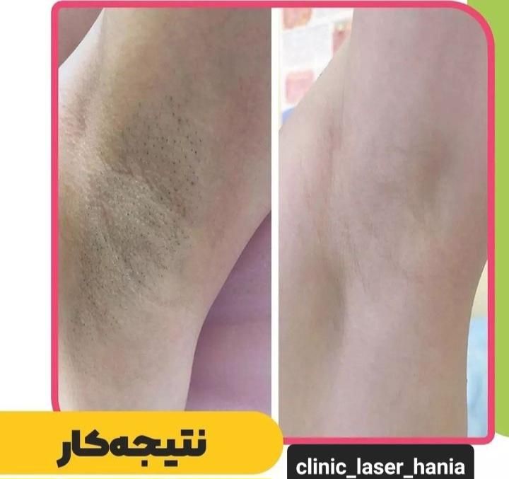 جشنواره بهاری لیزر موی زائد فول ۴۲۰ به مدت محدود|خدمات آرایشگری و زیبایی|ارومیه, |دیوار