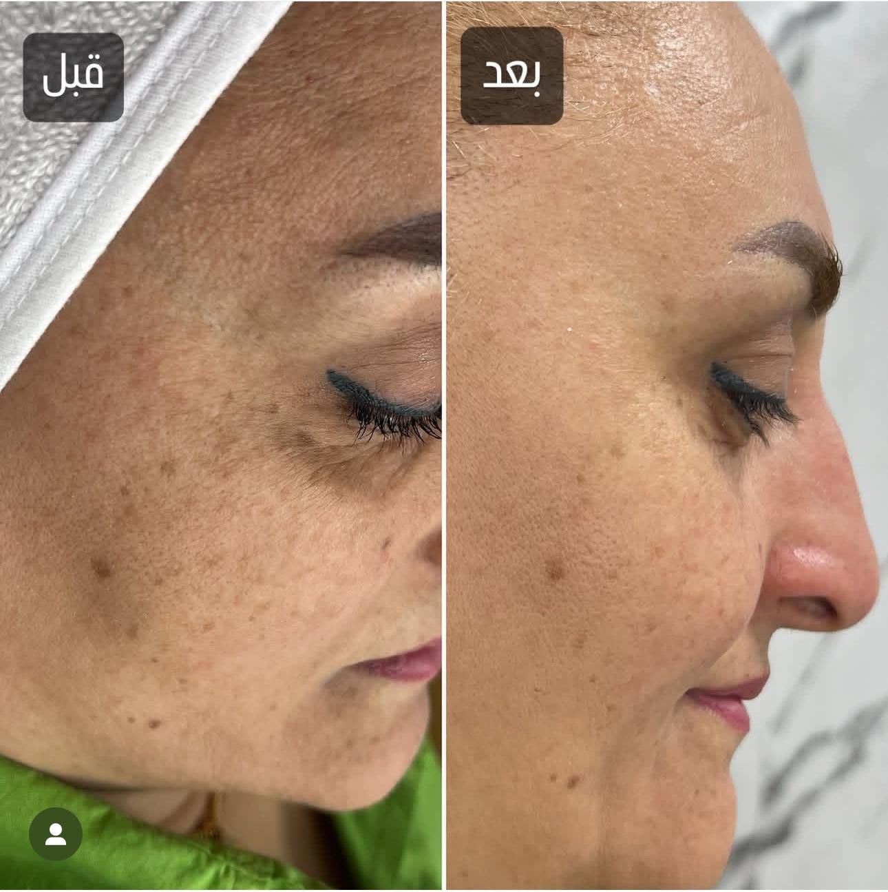 جشنواره خدمات تخصصی لیزر و فیشیال،برداشتن خال و لک|خدمات آرایشگری و زیبایی|کرج, مهرویلا جنوبی|دیوار