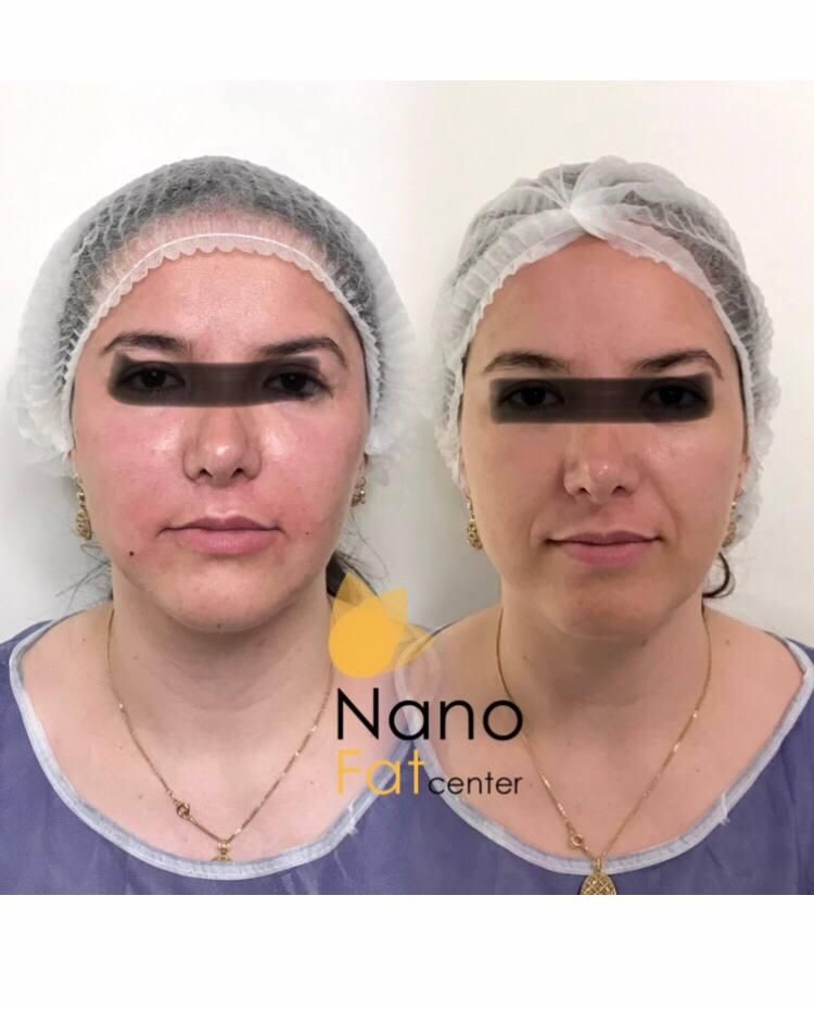 تزریق چربی صورت دست با سن بیکینی در کلینیک تخصصی|خدمات آرایشگری و زیبایی|تهران, صادقیه|دیوار