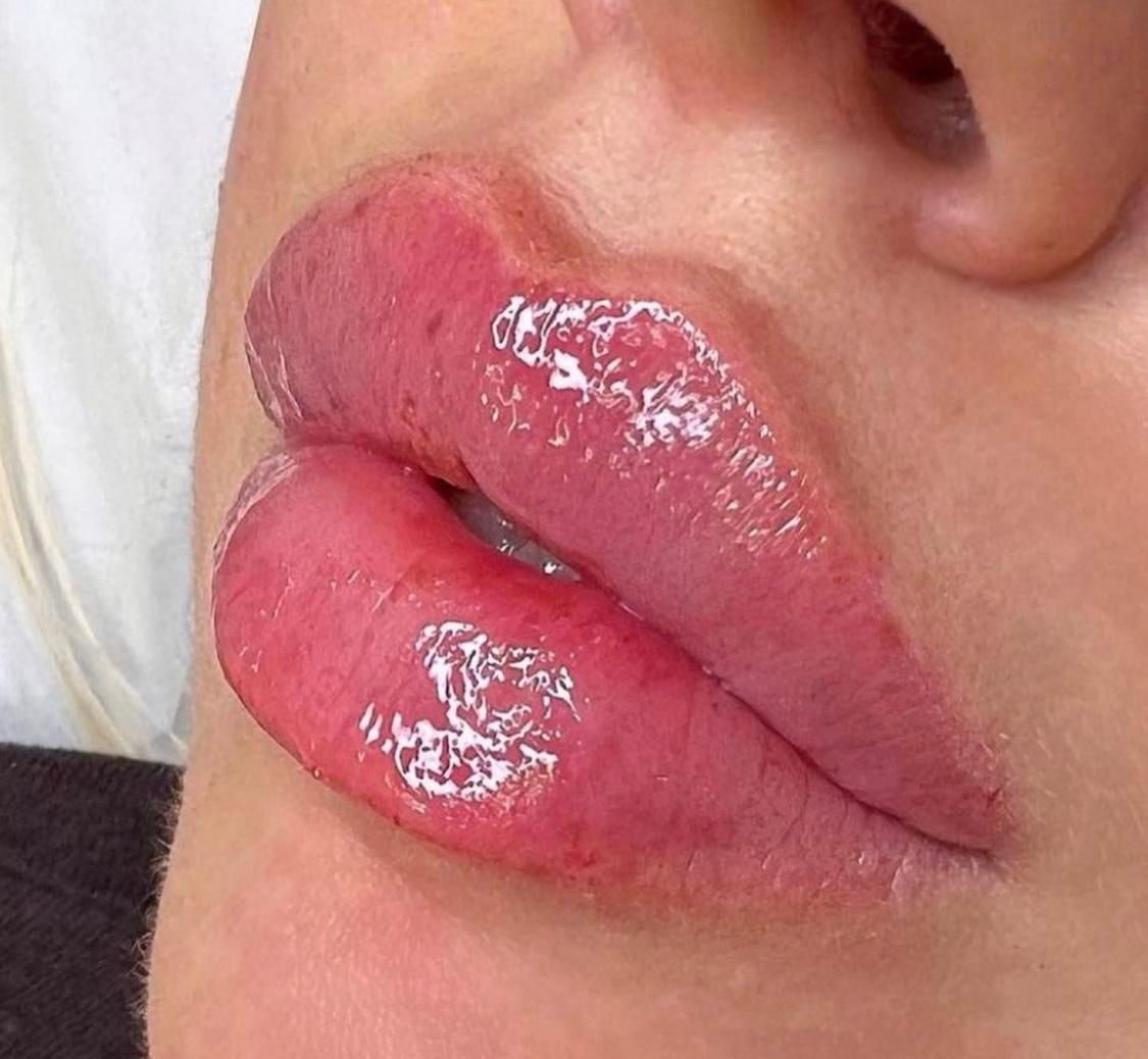 تزریق ژل لب روسی آنزیم زاویه سازی لیزر توسط پزشک|خدمات آرایشگری و زیبایی|تهران, صادقیه|دیوار