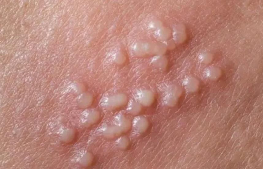 درمان زگیل،تبخال تناسلی خانمهاو آقایان،درمطب متخصص|خدمات آرایشگری و زیبایی|تبریز, |دیوار