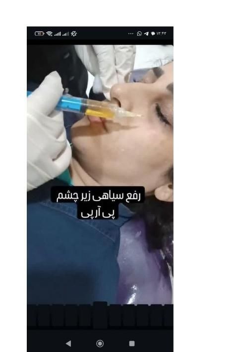 فیلرژل بوتاکس پی ارپی لاغر تزریق چربی مزولیزرهایفو|خدمات آرایشگری و زیبایی|تبریز, |دیوار