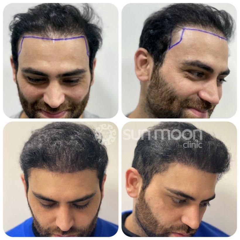 کاشت مو و ابرو تیم شیرازی در قزوین ، جشنواره اقساط|خدمات آرایشگری و زیبایی|قزوین, |دیوار