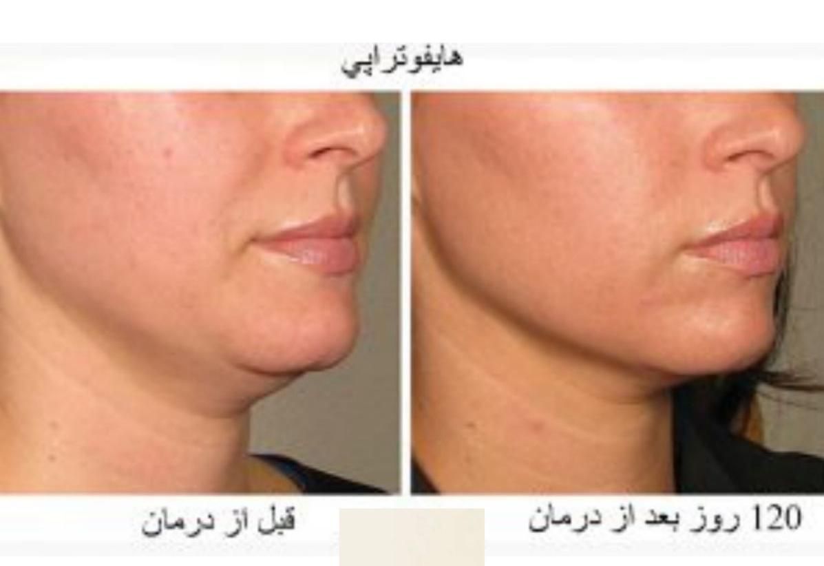هایفوتراپی لیفت صورت رفع غبغب|خدمات آرایشگری و زیبایی|تهران, میرداماد|دیوار