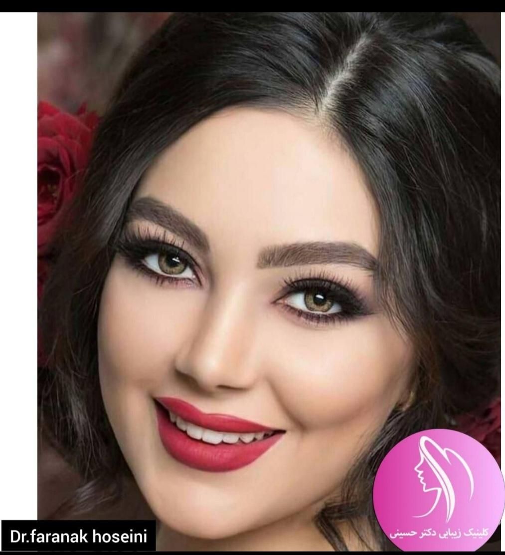 تزریق ژل لب روسی بوتاکس هایفو لیزر فیلر لیفت صورت|خدمات آرایشگری و زیبایی|تهران, ستارخان|دیوار