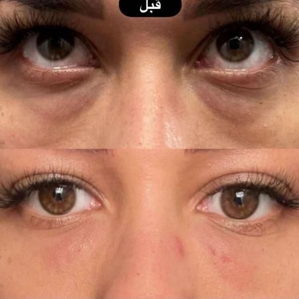 درمان قطعی و جوانسازی گودی .تیرگی و چروک زیر چشم|خدمات آرایشگری و زیبایی|مشهد, سناباد|دیوار