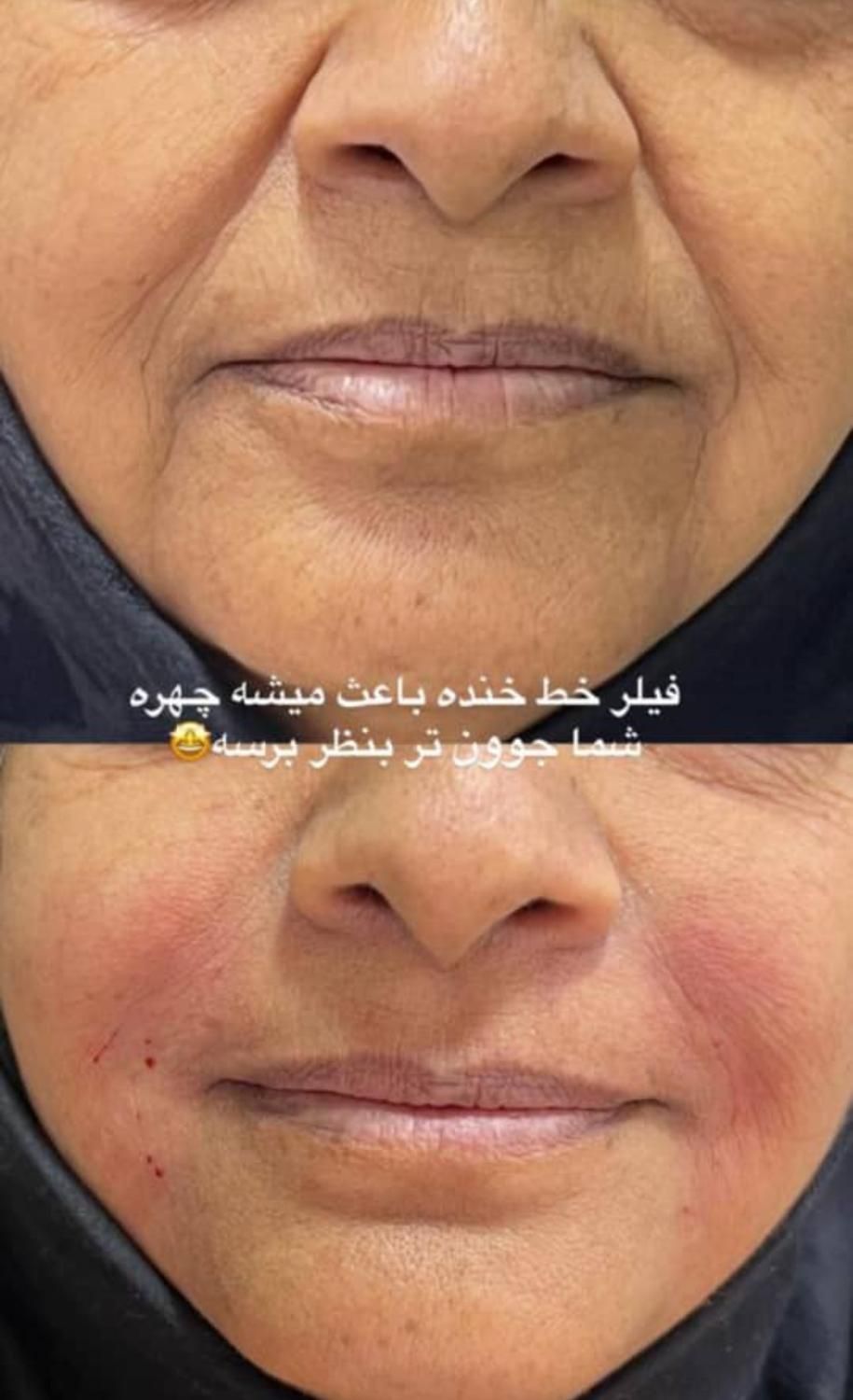 تزریق و آموزش انواع فیلرو بوتاکس|خدمات آرایشگری و زیبایی|مشهد, فرهنگیان (شهرک غرب)|دیوار