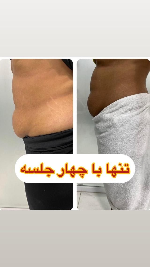 لاغری شکم پهلو پاک کردن ابرو فیشیال کوچک کردن بینی|خدمات آرایشگری و زیبایی|بندر ماهشهر, |دیوار