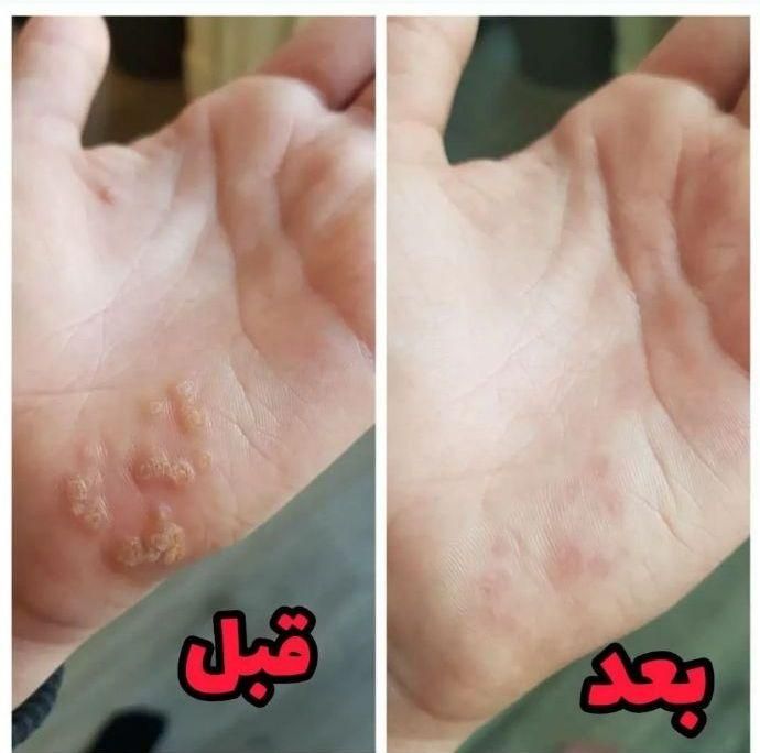 برطرف کردن زگیل با روش گیاهی و ریشه ای|خدمات آرایشگری و زیبایی|زنجان, |دیوار