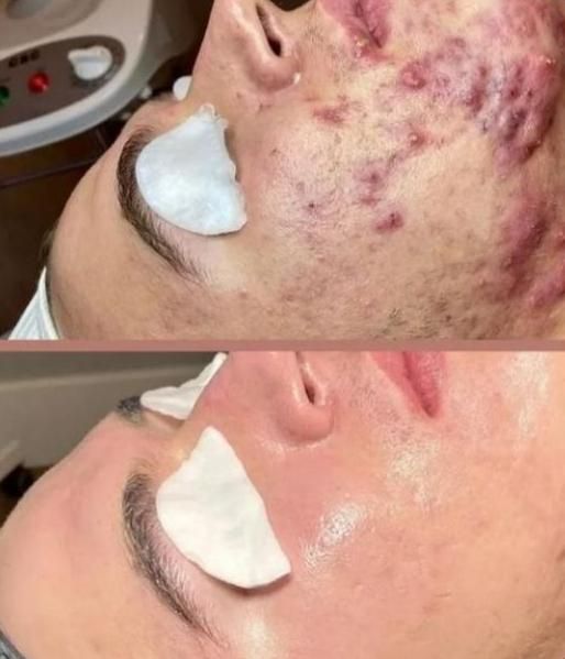 پاکسازی پوست،مطب سوپر فشیال تخصصی اقایان و بانوان|خدمات آرایشگری و زیبایی|تهران, نارمک|دیوار