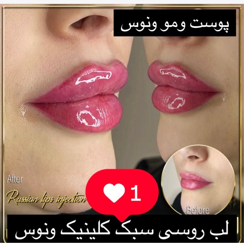 جشنواره50%تزریق ژل390مادلینگ هایفو لیزر مو ‌زائد|خدمات آرایشگری و زیبایی|تهران, ستارخان|دیوار