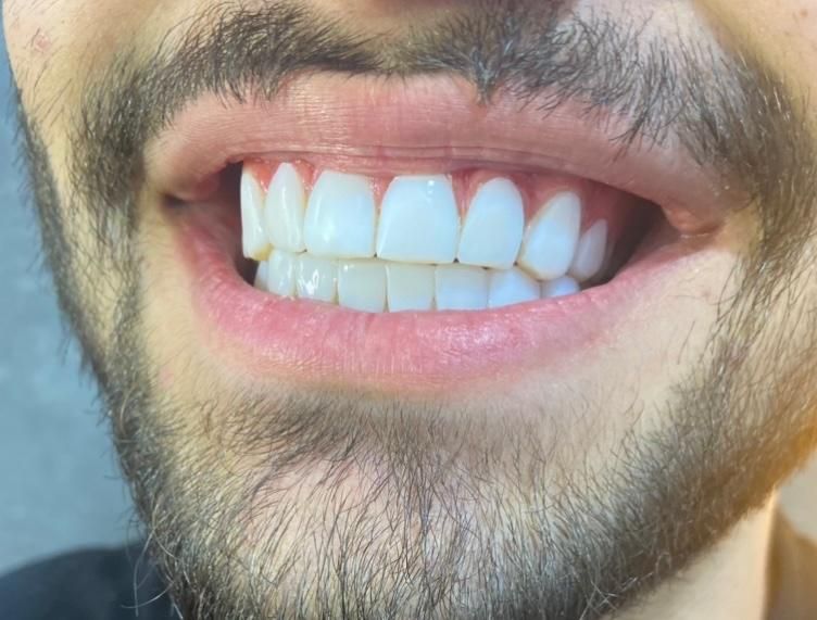 کامپوزیت دندان|خدمات آرایشگری و زیبایی|اسلام‌شهر, شهرک مهدیه|دیوار