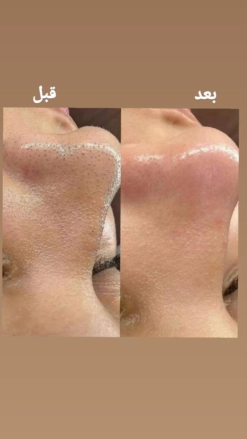 نیازمند مدل پاکسازی فقد هزینه متریال گرفته میشه|خدمات آرایشگری و زیبایی|امیدیه, |دیوار