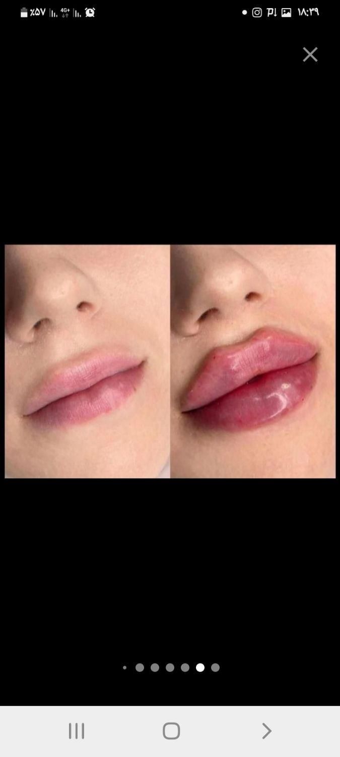 جشنواره پاییزه تزریق ژل وبوتاکس توسط پزشک متخصص|خدمات آرایشگری و زیبایی|بندرعباس, |دیوار