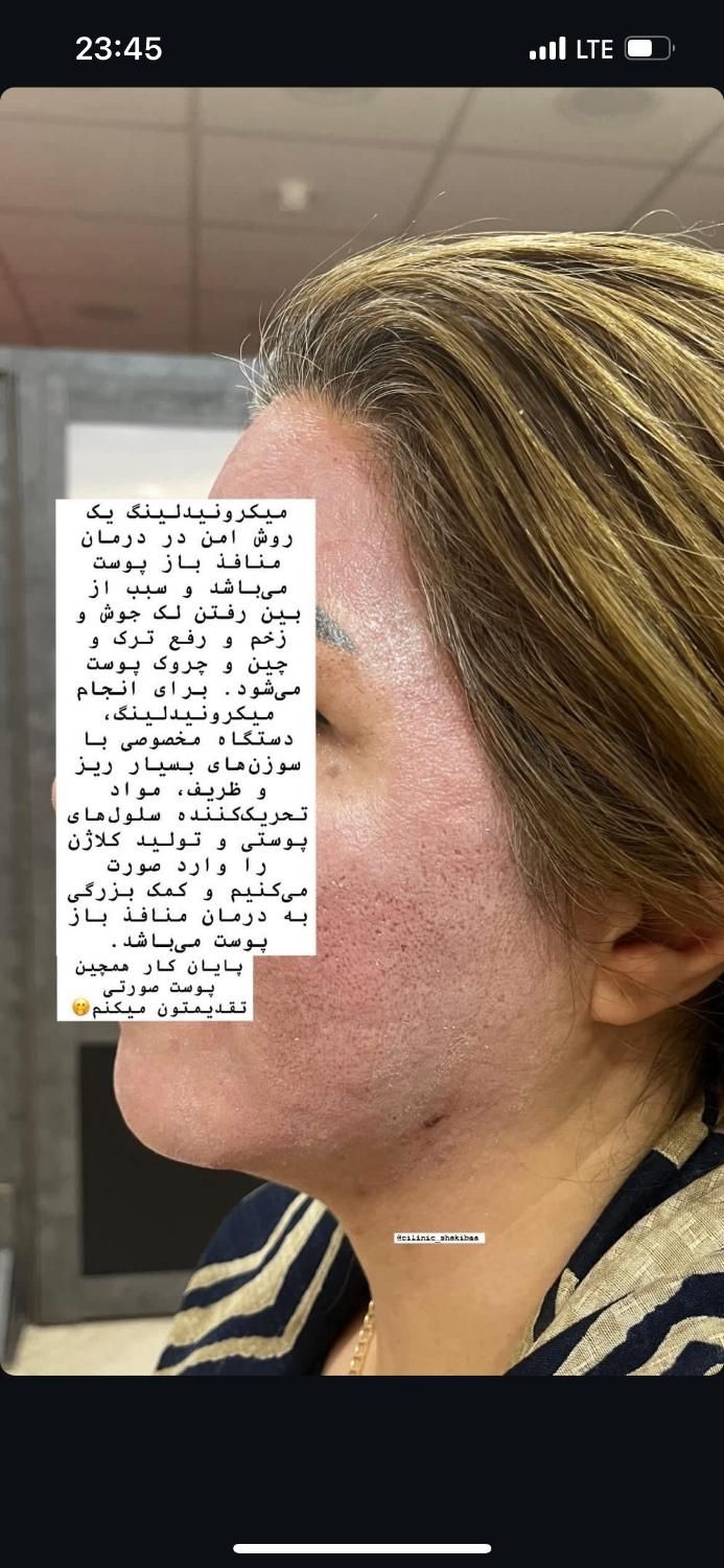 آموزش مزونیدلینگ و بوتاکس|خدمات آرایشگری و زیبایی|کوهدشت, |دیوار