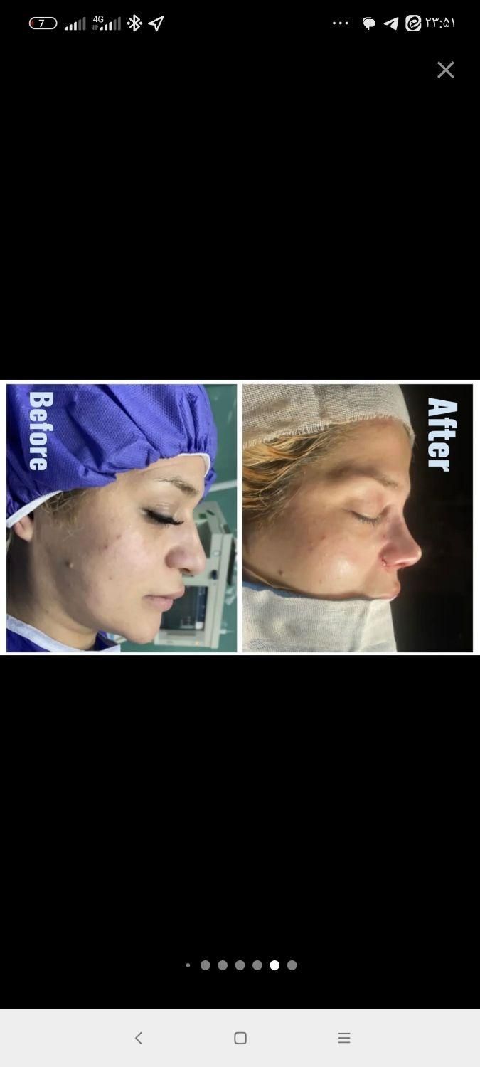 جراحی رینوپلاستی۲۷زیبایی بینی|خدمات آرایشگری و زیبایی|قم, بلوار امین و ساحلی|دیوار