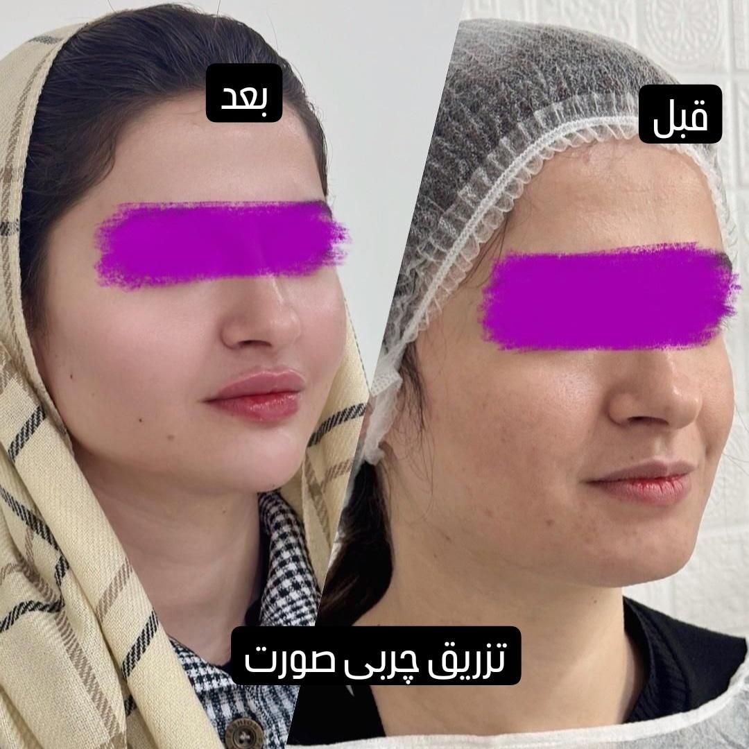 مژده ب همشهریان عزیزم آف چهل درصدی جراحی زیبایی|خدمات آرایشگری و زیبایی|دورود, |دیوار
