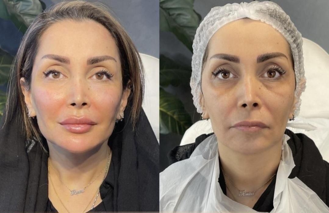 اصلاح فرم صورت.جوانسازی به روش یانگ فیس توسط متخصص|خدمات آرایشگری و زیبایی|مشهد, سناباد|دیوار