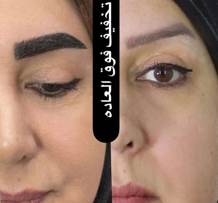 کاشت ابرو مو شقیقه ریش مزو تراپی نچرال طبیعی|خدمات آرایشگری و زیبایی|اصفهان, خانه اصفهان|دیوار
