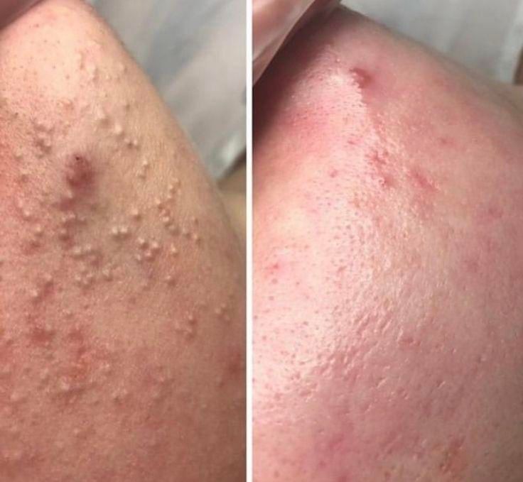 پاکسازی تخصصی پوست آقایان و بانوان|خدمات آرایشگری و زیبایی|گلستان (تهران), |دیوار