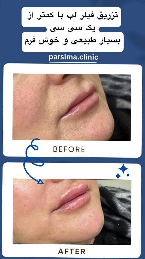 تخفیفات ویژه/اگزوزوم/مزو ژل/لیفتینگ/فشیال تخصصی|خدمات آرایشگری و زیبایی|شیراز, وحدت|دیوار
