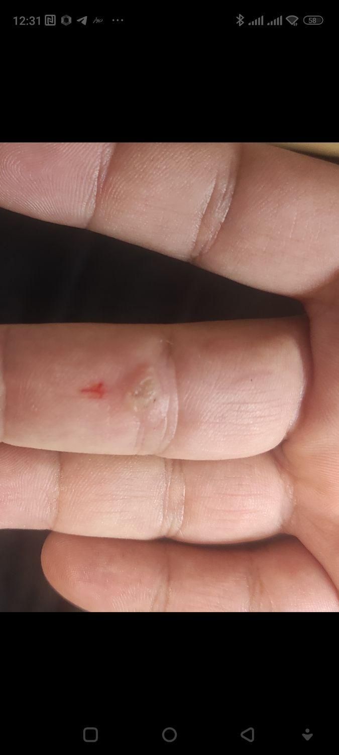 زگیل تناسلی|خدمات آرایشگری و زیبایی|تبریز, |دیوار