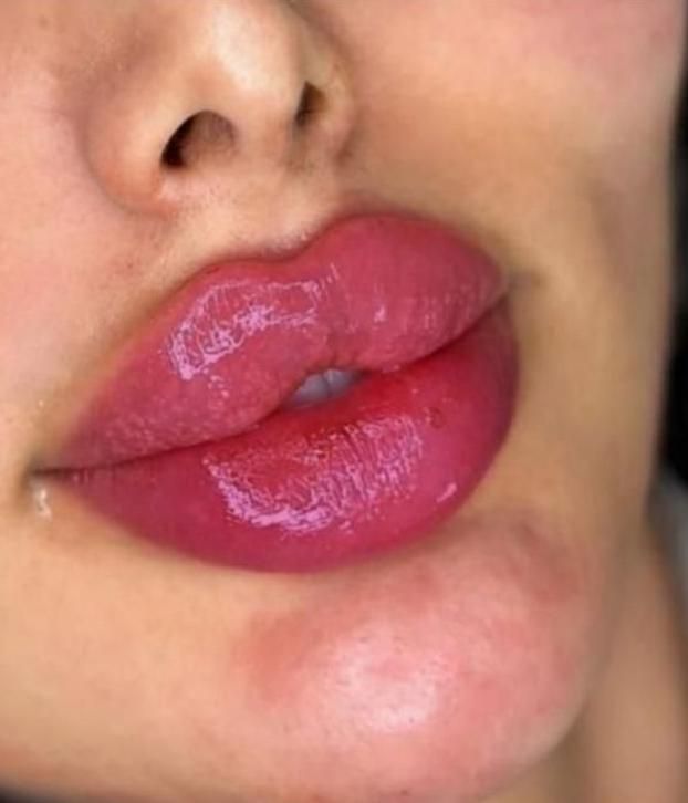 تخفیف ویژه فیلرلب،ژل،انزیم لب،بوتاکس،پی ار پی|خدمات آرایشگری و زیبایی|بندرعباس, |دیوار