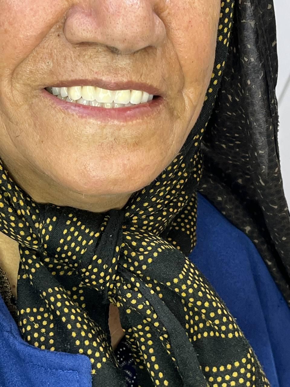 ساخت دندان مصنوعی تحویل یک روزه|خدمات آرایشگری و زیبایی|قم, بکایی|دیوار