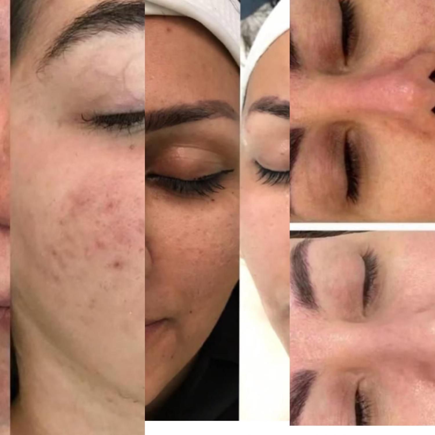 فیشیال تخصصی پوست|خدمات آرایشگری و زیبایی|سبزوار, فرهنگیان|دیوار