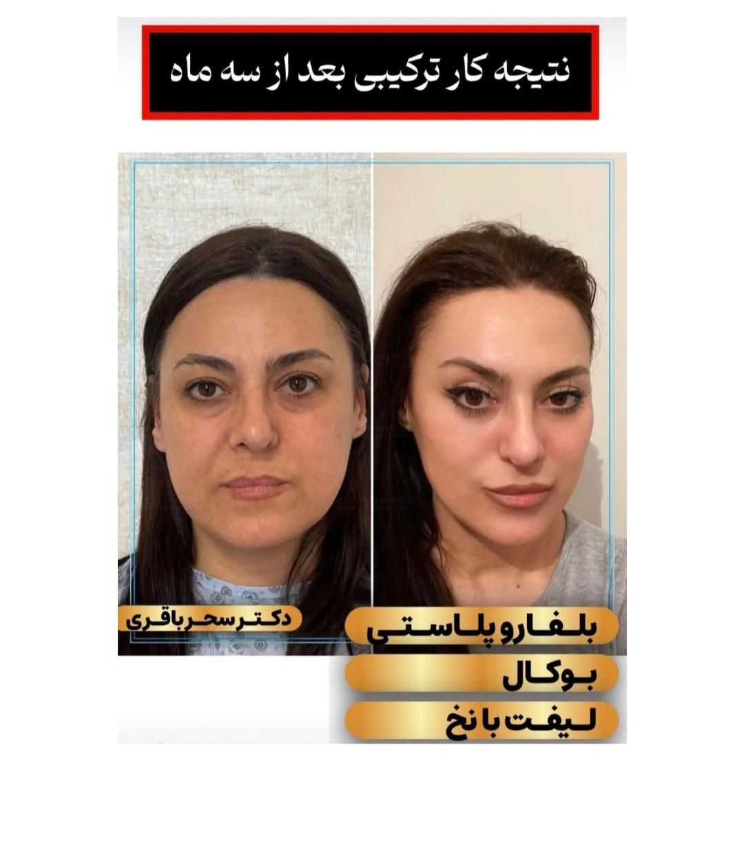 جراحی ساکشن غبغب به روش سوپرکانتورینگ|خدمات آرایشگری و زیبایی|تهران, صادقیه|دیوار