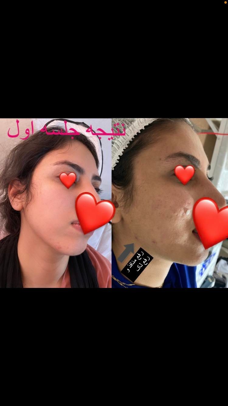 پاکسازی پوست فشیال لیزر پوست فیشیال|خدمات آرایشگری و زیبایی|شیراز, درکی|دیوار