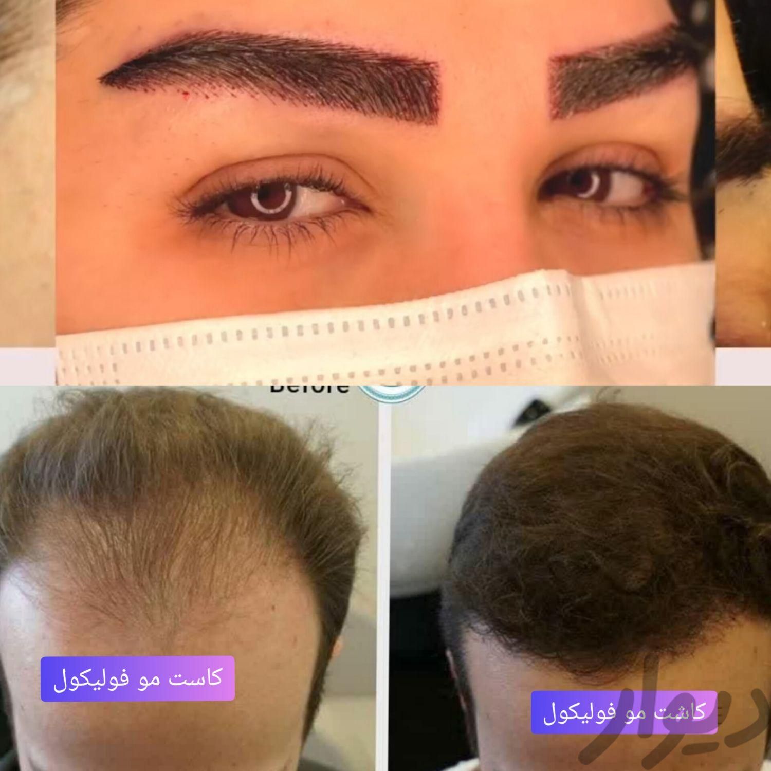 کاشت مو و ابرو در قزوین بیمارستان پاستور|خدمات آرایشگری و زیبایی|قزوین, |دیوار