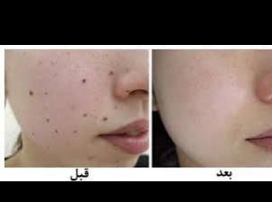 آموزش تتو بدن . پیرسینگ . چال گونه و برداشتن خال|خدمات آرایشگری و زیبایی|بروجرد, |دیوار