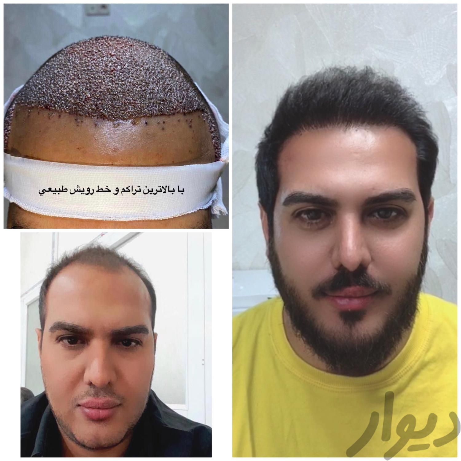 کاشت موی شیرازی تضمینی با تراکم بالا،خط رویش طبیعی|خدمات آرایشگری و زیبایی|یزد, |دیوار