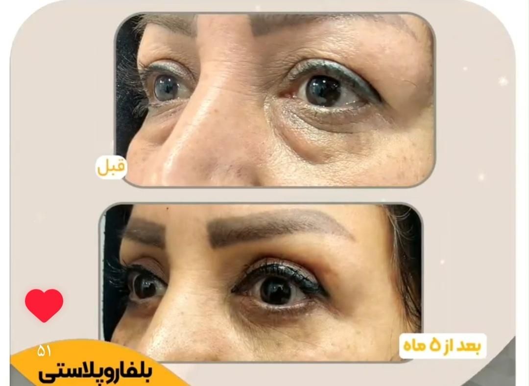 (شوش، شوشتر، اندیمشک) بلفاروپلاستی|خدمات آرایشگری و زیبایی|شوش, |دیوار