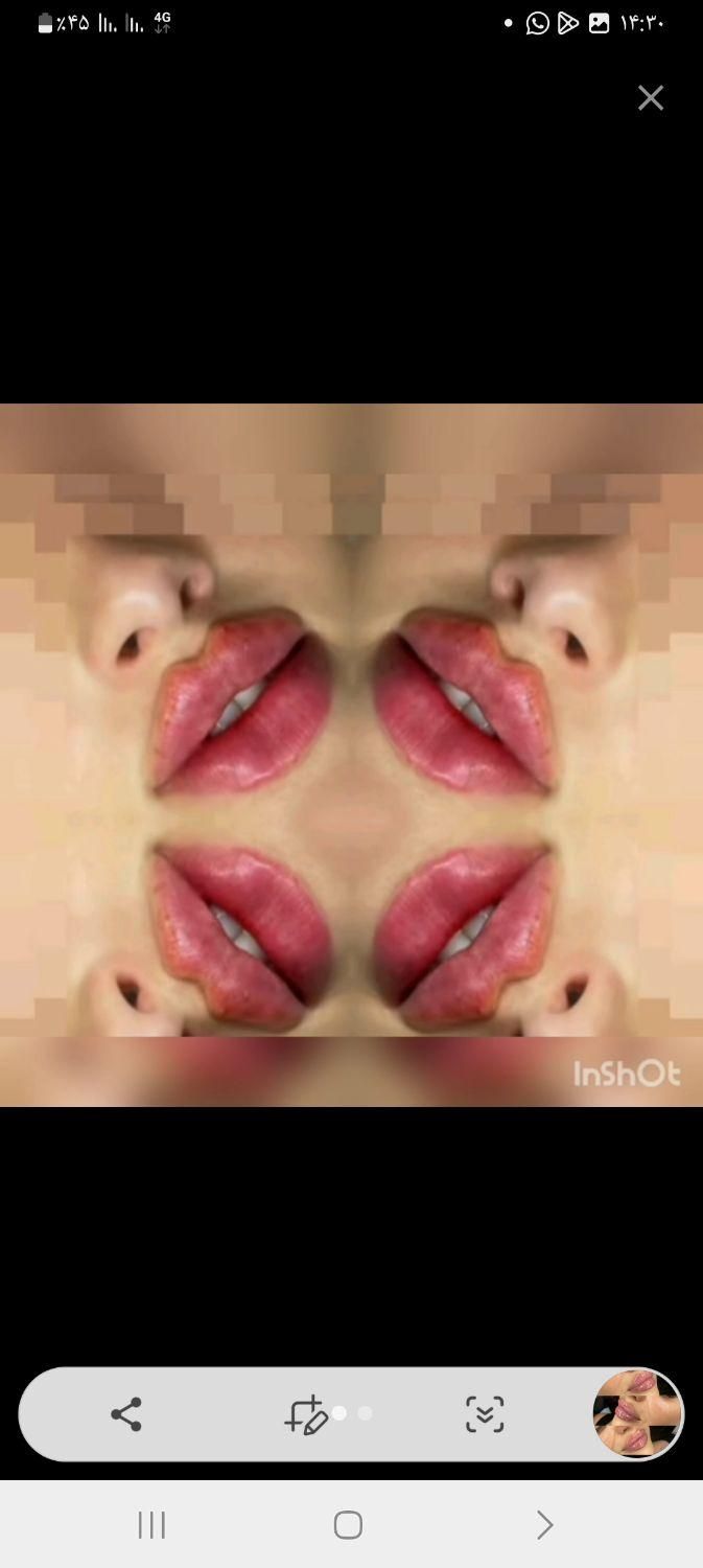 تزریق ژل لب صورت فیلر بوتاکس میکرونیلدینگ مزوتراپی|خدمات آرایشگری و زیبایی|شیراز, شهرک گلستان|دیوار