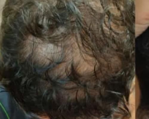 درمان ریزش مو و رشد مجدد مو فقط در چند جلسه|خدمات آرایشگری و زیبایی|قوچان, |دیوار