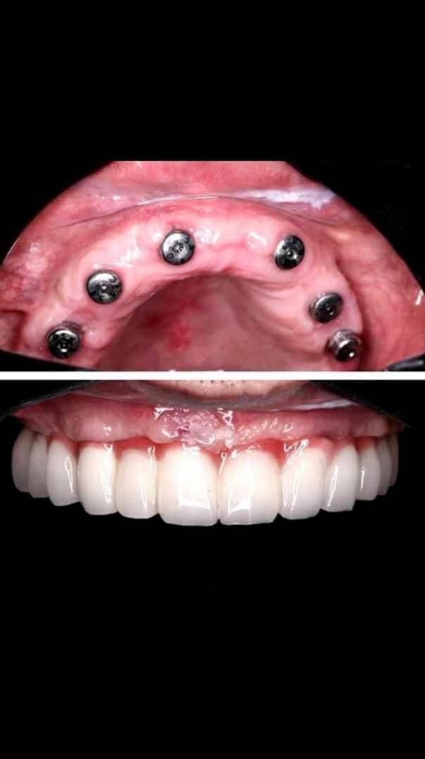 دندانپزشکی ایمپلنت اوردنچر روکش  تخصصی شمال غرب|خدمات آرایشگری و زیبایی|تبریز, |دیوار