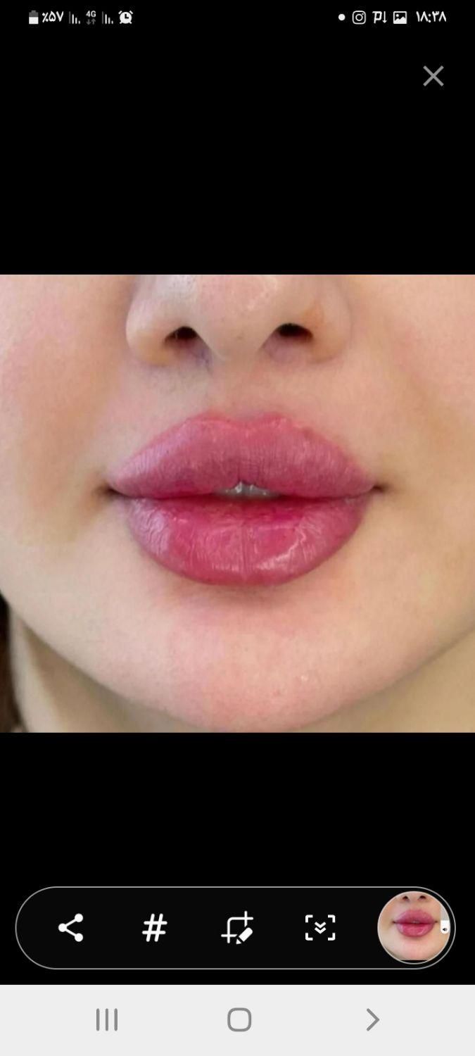 جشنواره پاییزه تزریق ژل وبوتاکس توسط پزشک متخصص|خدمات آرایشگری و زیبایی|بندرعباس, |دیوار